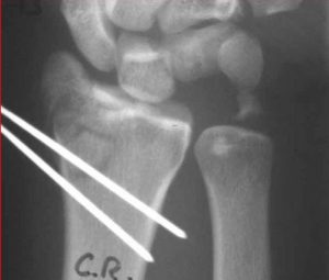 707px-Pins_across_a_distal_radius_fracture-300x255