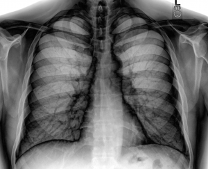 Chest_Xray_PA_3-8-2010_inverted-300x243
