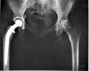 Hip_replacement_Image_3684-PH-300x241