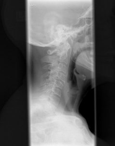 476px-Cervical_spine_Xray-238x300