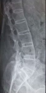 Ankylosing_spondylitis_lumbar_spine-150x300
